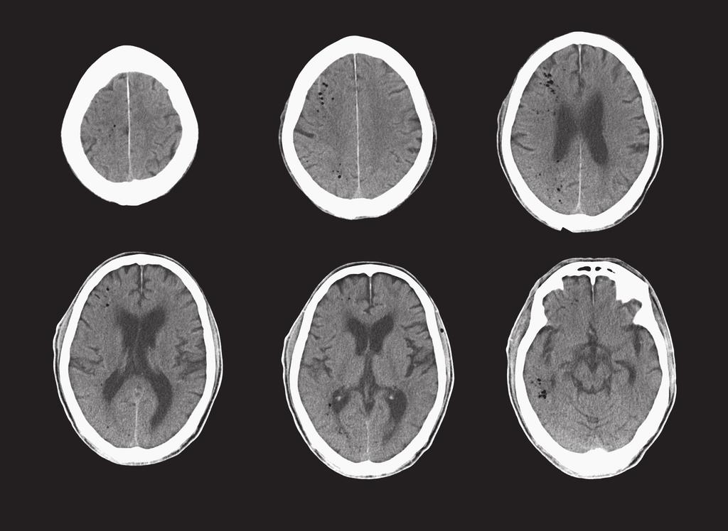 53 110 臨床神経学 53 巻 2 号 2013 2 Fig. 1 Brain computed tomography (CT) after 30 minutes from onset.