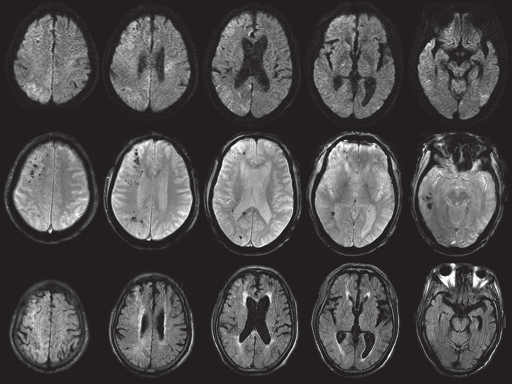 2 Brain magnetic resonance (MR) images after 2 hours from onset. (Signa Excite 1.5T, GE Healthcare) Diffusion weighted images (DWI) (Axial, 1.5T; TR 10,000 ms, TE 89.