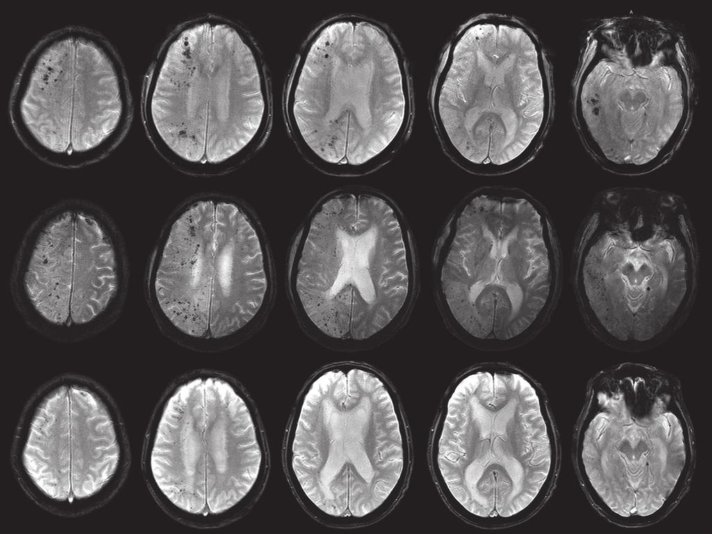 53 111 脳空気塞栓症の 1 例 Fig. 3 Serial T2* weighted images. Many hypointense spots were shown in the right cerebral hemisphere after 2 hours from onset (Axial, Signa Excite 1.