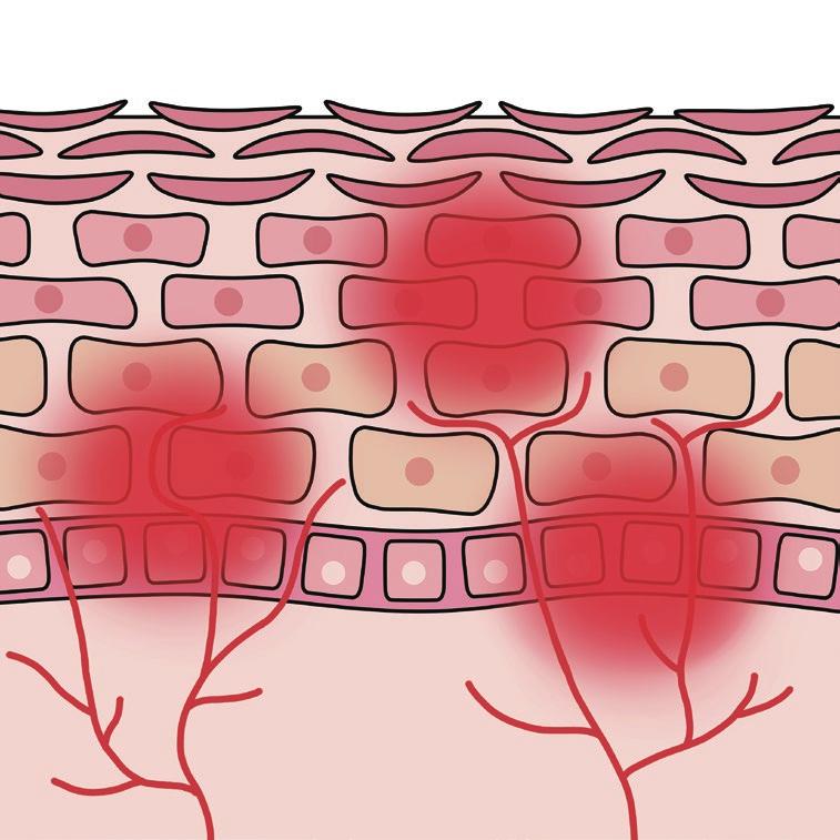 アトピー性皮膚炎の原因 アトピー性皮膚炎の治療 アトピー性皮膚炎の原因はまだ明らかではありませんが 皮膚のバリア機能が低下する体質や