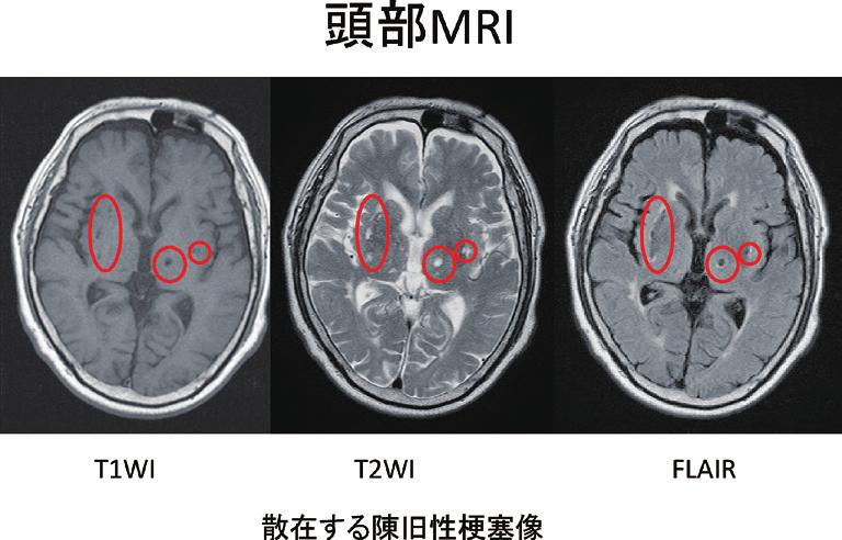 2014 年 7 月 第 436 回東京医科大学臨床懇話会 255 図2 エコーでの狭窄率の評価は血管径から測定する NASCET 法と ECST 法がある 流速と狭窄度の相関も示唆されて いる 図3 頭部 MRI では T1 で低信号 T2 で高信号 FLAIR で内部が低信号 周囲が高信号を呈する陳旧性脳梗塞が両側大 脳基底核に散在していた 頸部 MRI の T1 Black Blood