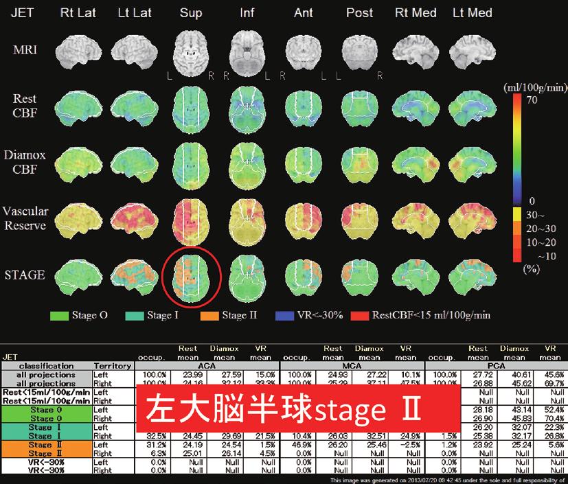 2014 年 7 月 第 436 回東京医科大学臨床懇話会 図6 257 脳血流 SPECT にて左大脳半球は Stage II の虚血状態であると評価した に 1 回のペースで CT をフォローアップして 落ち いわゆる生活習慣病の危険因子 5 大ファクターと ついたところで退院というのが基本的な B 型解離 か言いますが これを有していたこと 動脈硬化の の管理です