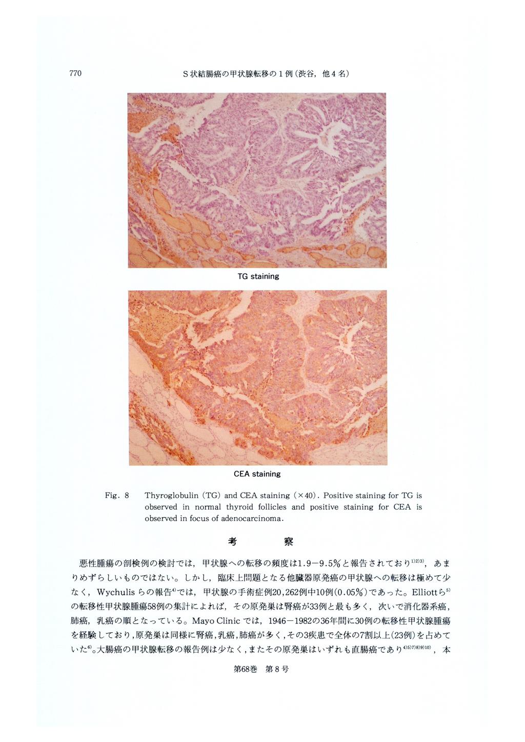 770 S状 結 腸 癌 の 甲状 腺 転移 の1例(渋 Fig. 8 谷,他4名) Thyroglobulin (TG) and CEA staining ( x 40).