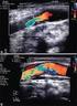 2, 12 Figure 1 Various methods of measuring carotid stenosis via ultrasound examination. Figure 2 Incidence of vascular events in medical treatment pa